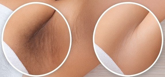 Genital Bölge Neden Koyulaşır? ve Renk Açma Nasıl Yapılır?